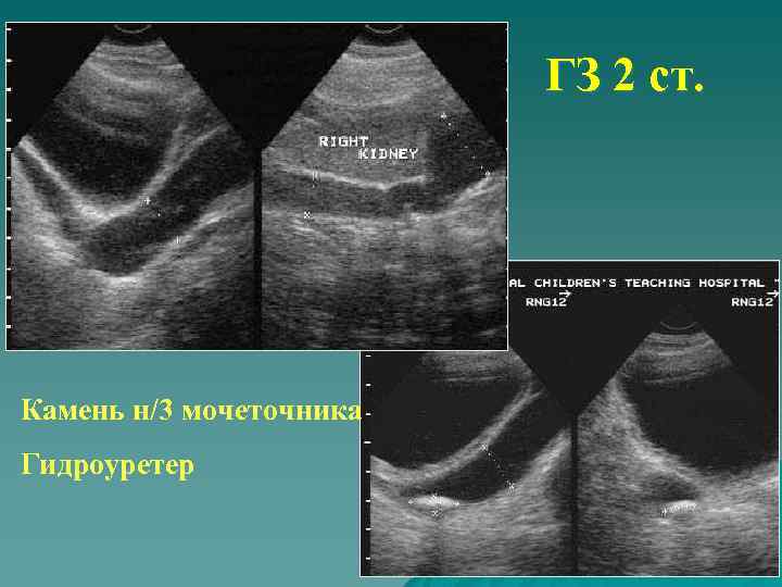 ГЗ 2 ст. Камень н/3 мочеточника Гидроуретер 