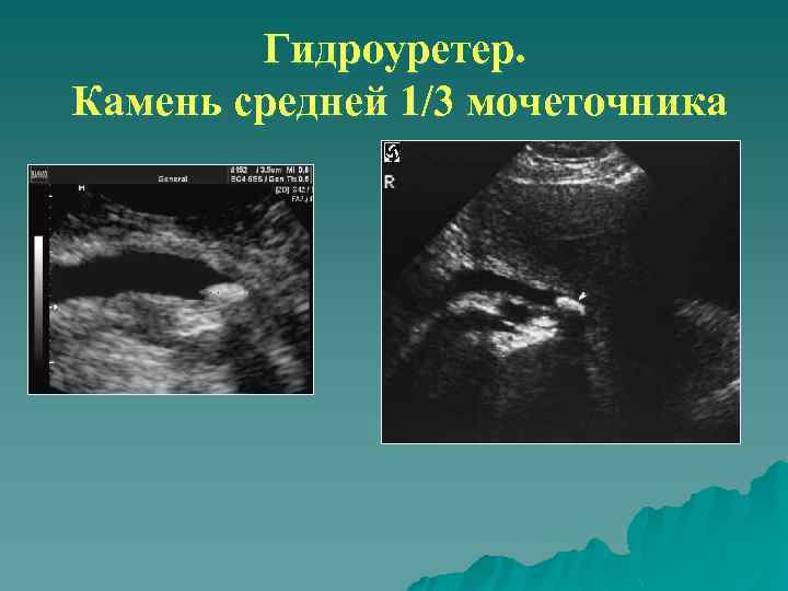 Гидроуретер. Камень средней 1/3 мочеточника 