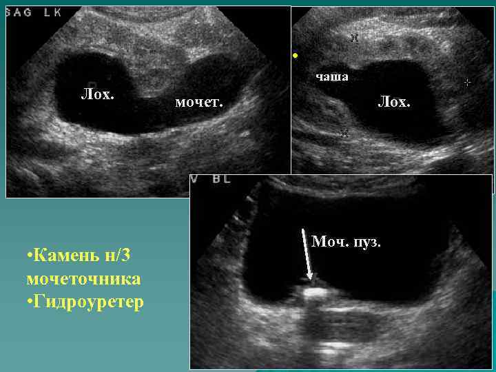 ГЗ 2 ст. чаша Лох. • Камень н/3 мочеточника • Гидроуретер мочет. Лох. Моч.
