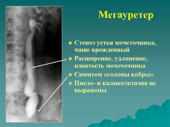 Мегауретер Стеноз устья мочеточника, чаще врожденный u Расширение, удлинение, извитость мочеточника u Симптом «головы