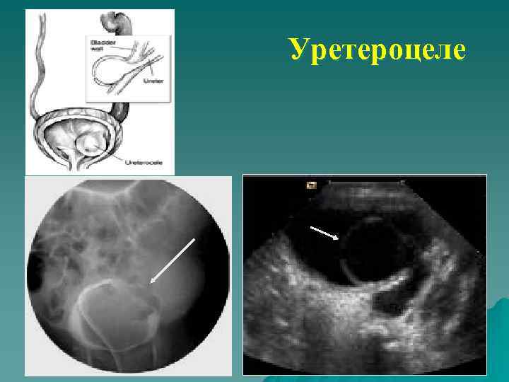 Уретероцеле 