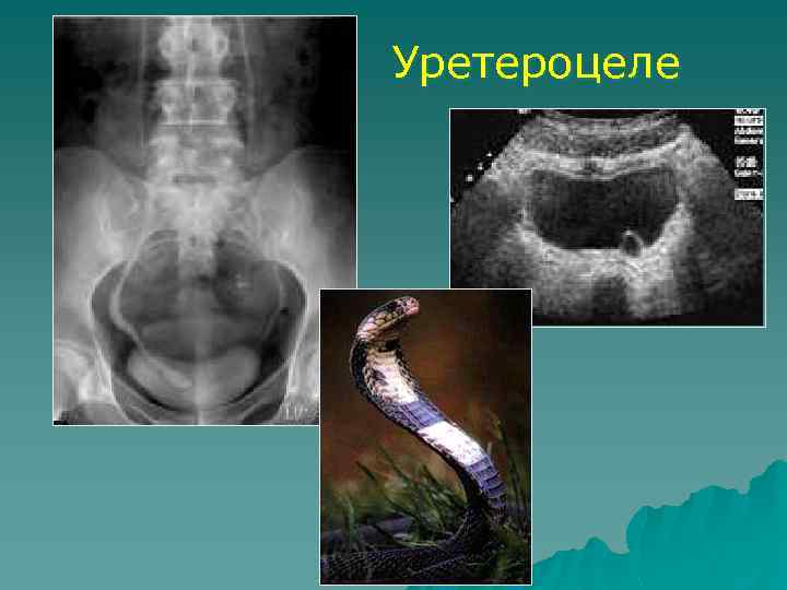 Уретероцеле 