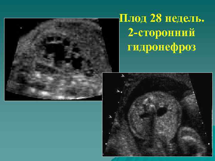 Плод 28 недель. 2 -сторонний гидронефроз 