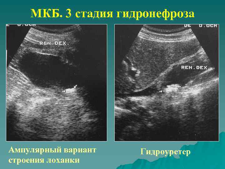 МКБ. 3 стадия гидронефроза Ампулярный вариант строения лоханки Гидроуретер 