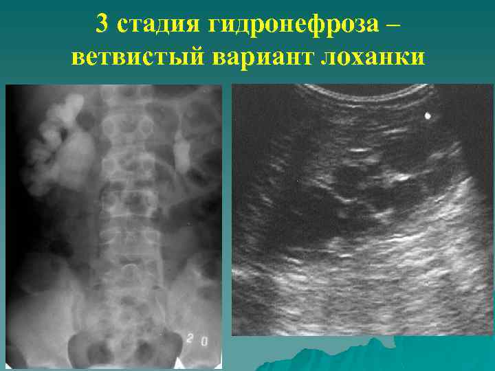 3 стадия гидронефроза – ветвистый вариант лоханки 