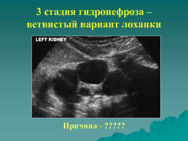 3 стадия гидронефроза – ветвистый вариант лоханки Причина - ? ? ? 