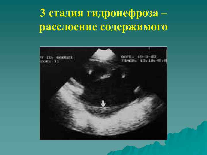 3 стадия гидронефроза – расслоение содержимого 