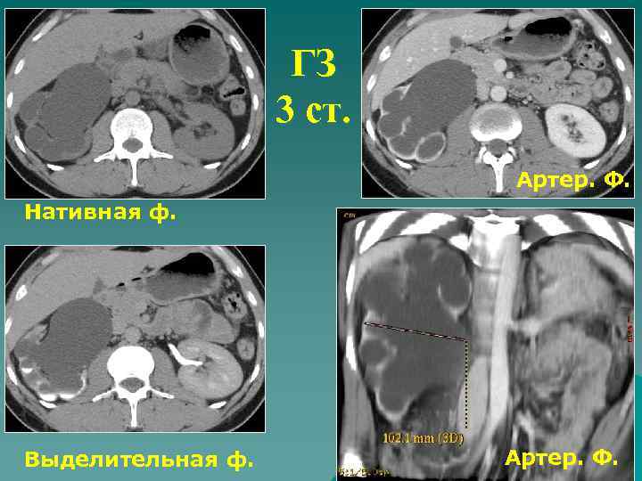 ГЗ 3 ст. Артер. Ф. Нативная ф. Выделительная ф. Артер. Ф. 