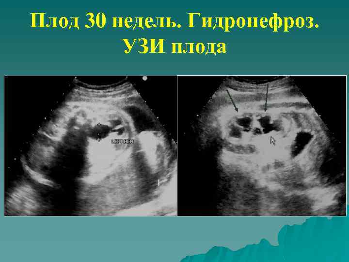 Плод 30 недель. Гидронефроз. УЗИ плода 