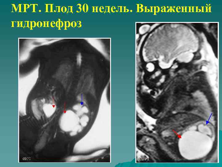 МРТ. Плод 30 недель. Выраженный гидронефроз 