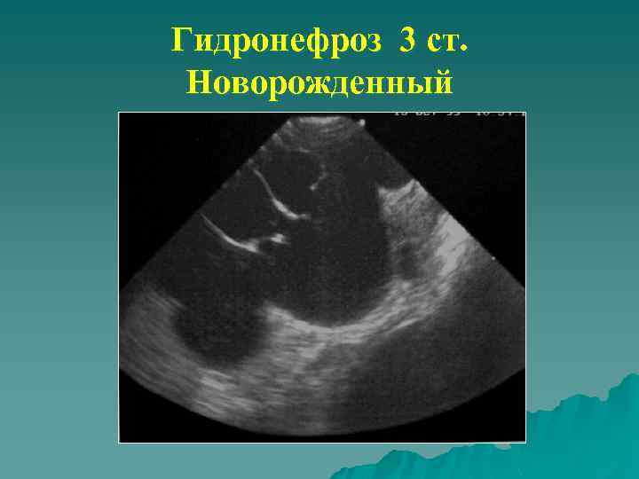 Гидронефроз 3 ст. Новорожденный 