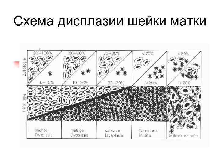 Схема дисплазии шейки матки 