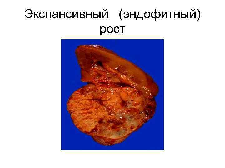 Экспансивный (эндофитный) рост 