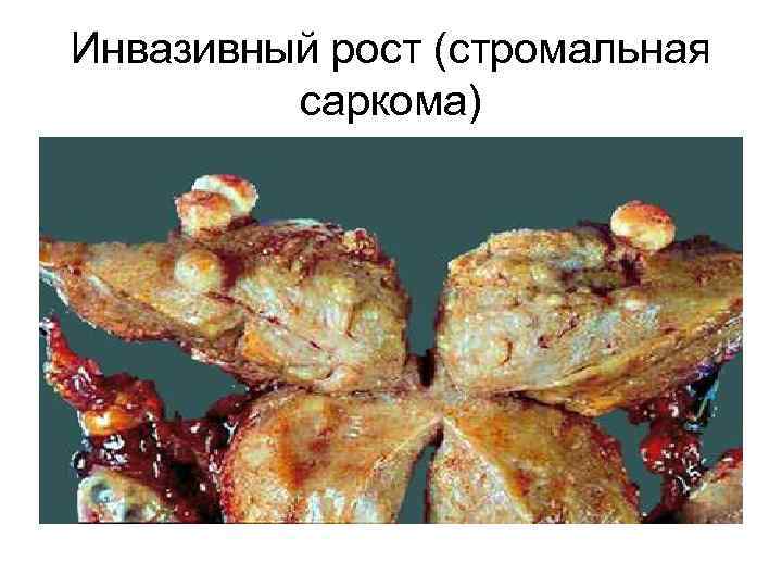 Инвазивный рост (стромальная саркома) 