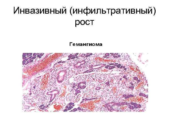 Инвазивный (инфильтративный) рост 