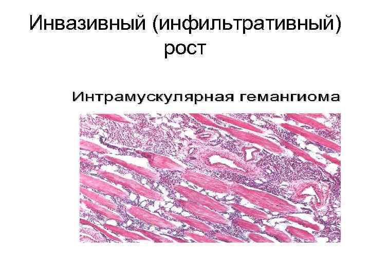 Инвазивный (инфильтративный) рост 
