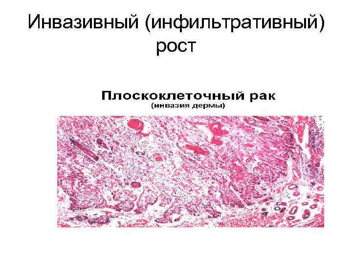 Инвазивный (инфильтративный) рост 