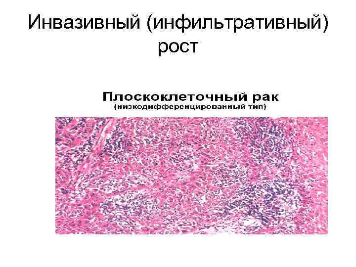 Инвазивный (инфильтративный) рост 
