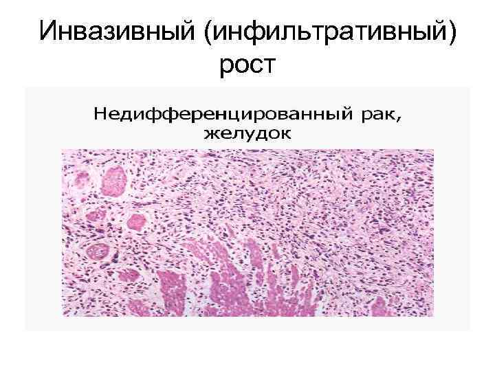 Инвазивный (инфильтративный) рост 