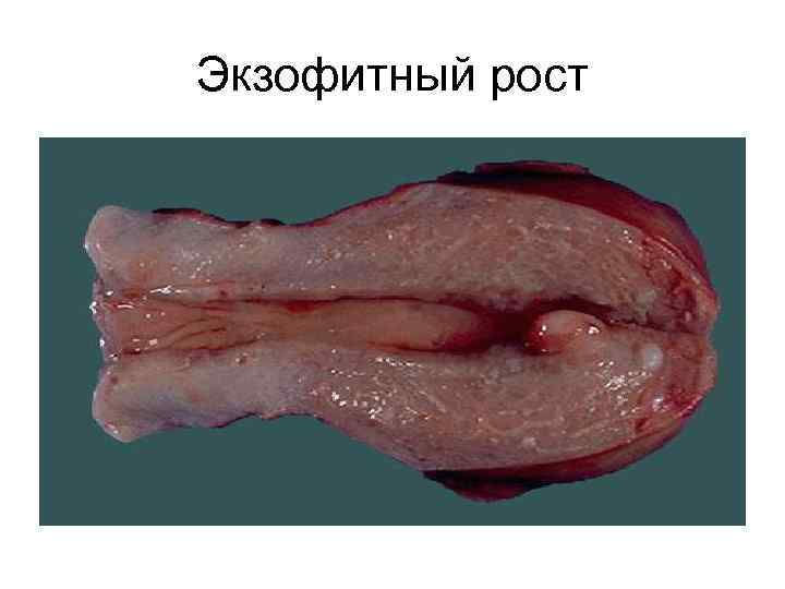 Экзофитный рост 