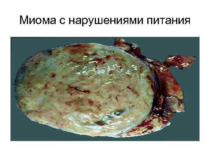 Миома с нарушениями питания 