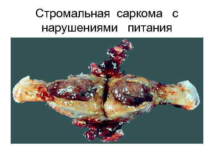 Стромальная саркома с нарушениями питания 