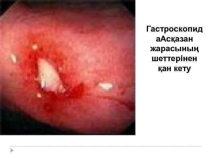 Гастроскопид а. Асқазан жарасының шеттерінен қан кету 