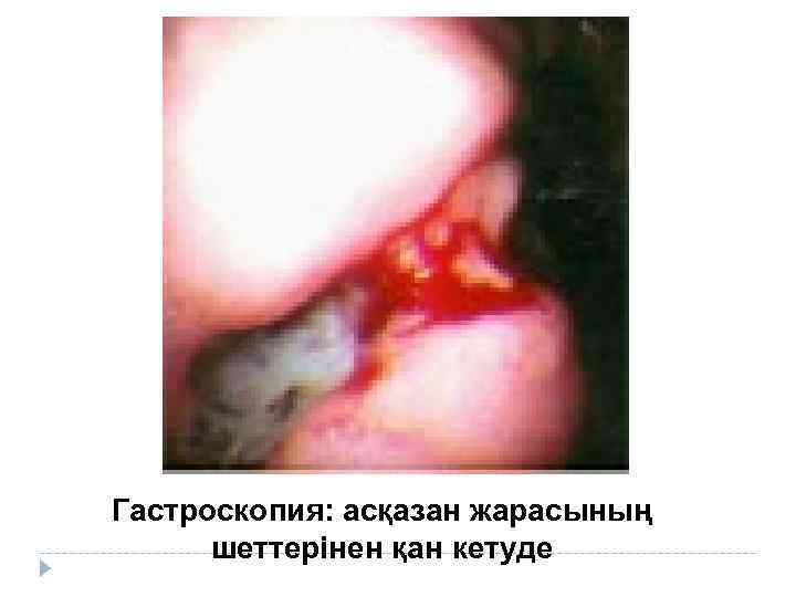 Гастроскопия: асқазан жарасының шеттерінен қан кетуде 