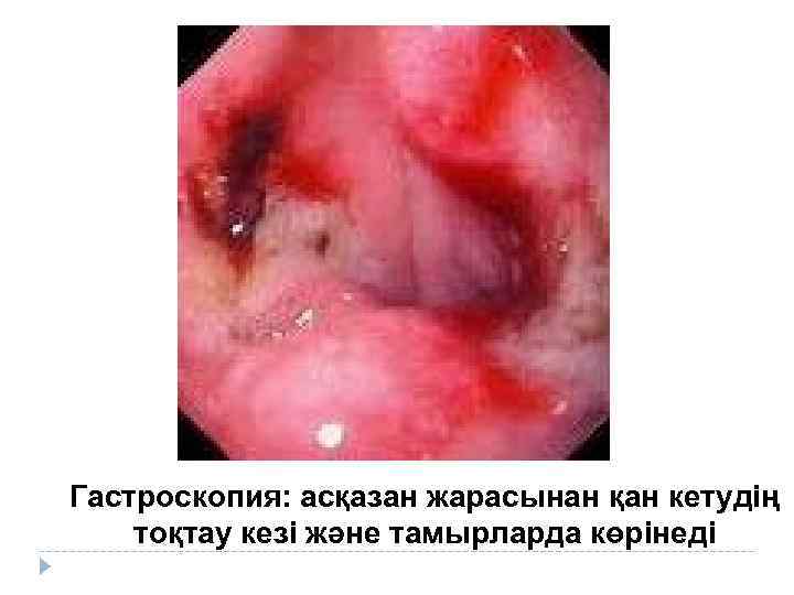 Гастроскопия: асқазан жарасынан қан кетудің тоқтау кезі және тамырларда көрінеді 