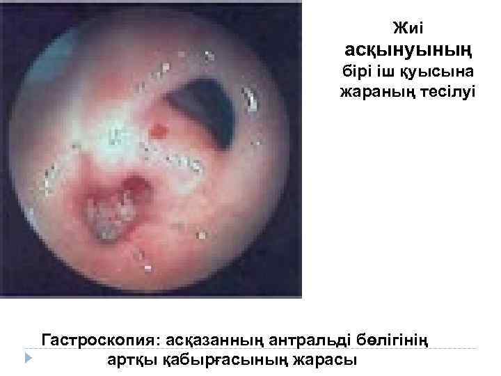 Жиі асқынуының бірі іш қуысына жараның тесілуі Гастроскопия: асқазанның антральді бөлігінің артқы қабырғасының жарасы