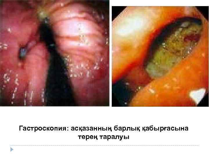 Гастроскопия: асқазанның барлық қабырғасына терең таралуы 