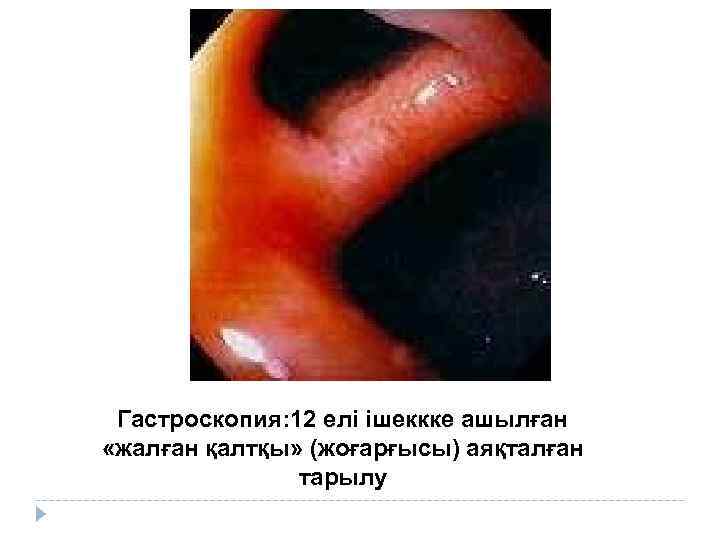 Гастроскопия: 12 елі ішеккке ашылған «жалған қалтқы» (жоғарғысы) аяқталған тарылу 