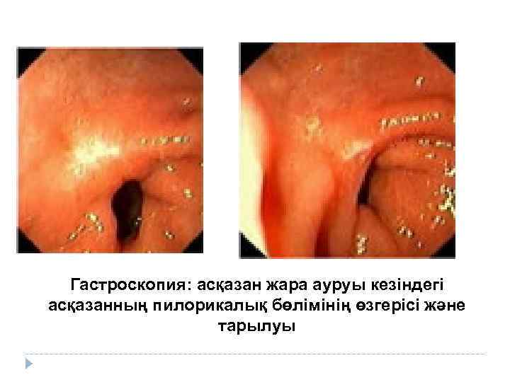 Гастроскопия: асқазан жара ауруы кезіндегі асқазанның пилорикалық бөлімінің өзгерісі және тарылуы 