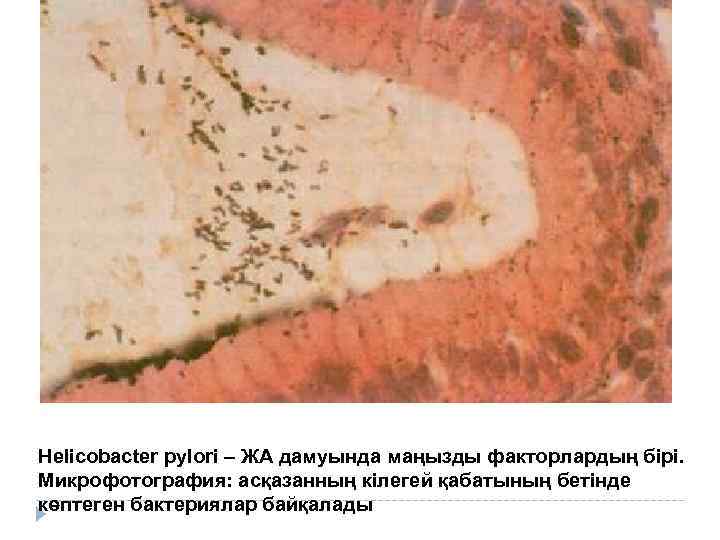 Helicobacter pylori – ЖА дамуында маңызды факторлардың бірі. Микрофотография: асқазанның кілегей қабатының бетінде көптеген