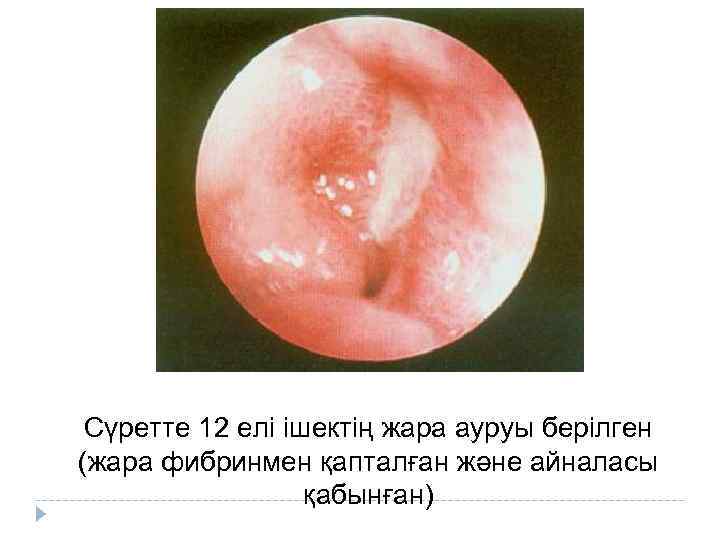 Сүретте 12 елі ішектің жара ауруы берілген (жара фибринмен қапталған және айналасы қабынған) 