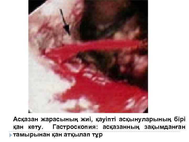 Асқазан жарасының жиі, қауіпті асқынуларының бірі қан кету. Гастроскопия: асқазанның зақымданған тамырынан қан атқылап
