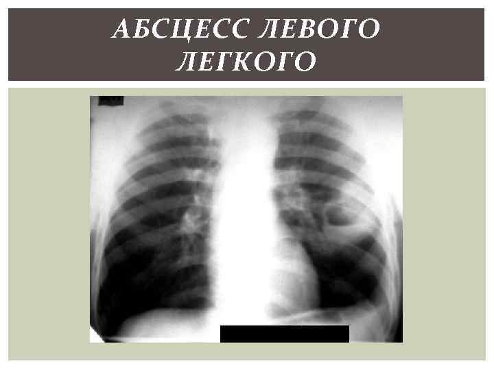 АБСЦЕСС ЛЕВОГО ЛЕГКОГО 