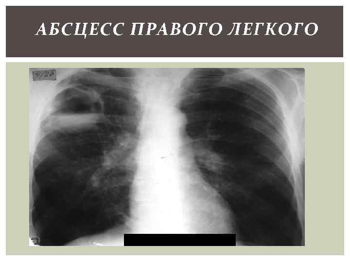 АБСЦЕСС ПРАВОГО ЛЕГКОГО 