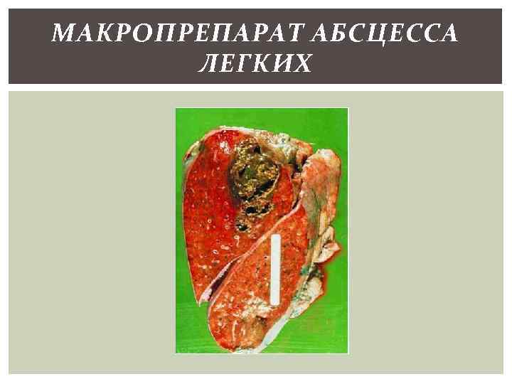 МАКРОПРЕПАРАТ АБСЦЕССА ЛЕГКИХ 