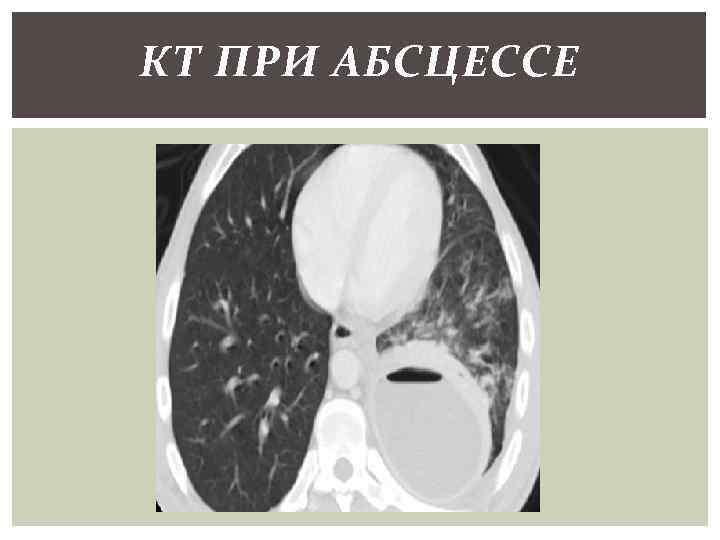 КТ ПРИ АБСЦЕССЕ 