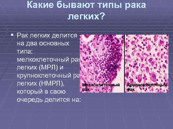 Какие бывают типы рака легких? § Рак легких делится на два основных типа: мелкоклеточный