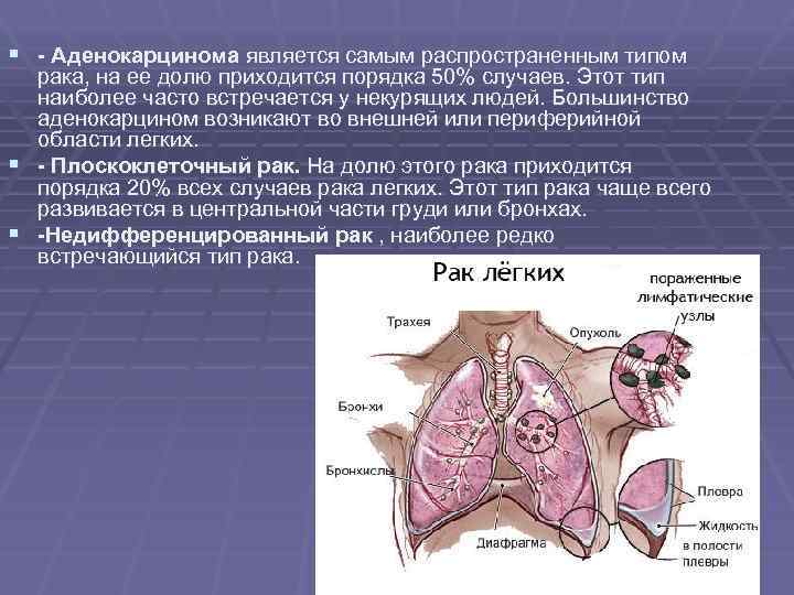 § - Аденокарцинома является самым распространенным типом рака, на ее долю приходится порядка 50%