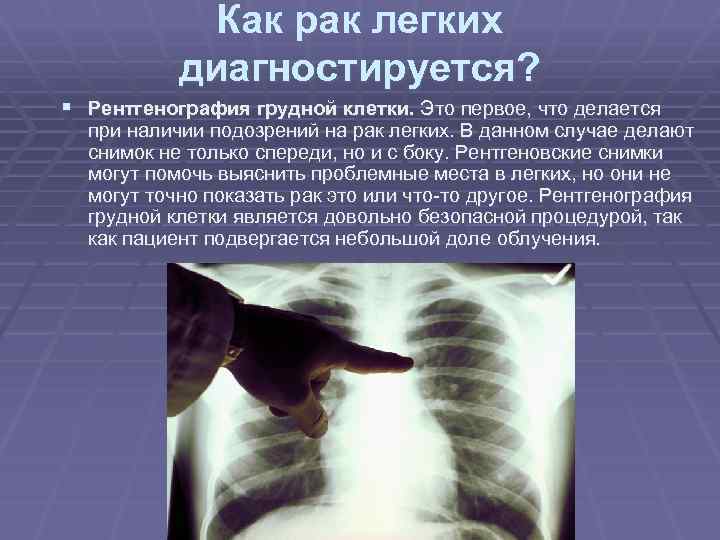 Как рак легких диагностируется? § Рентгенография грудной клетки. Это первое, что делается при наличии