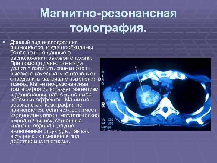 Магнитно-резонансная томография. § Данный вид исследования применяется, когда необходимы более точные данные о расположении