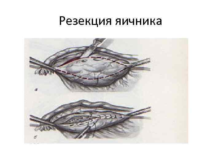 Резекция яичника 