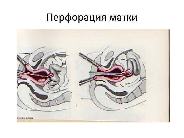 Перфорация матки 