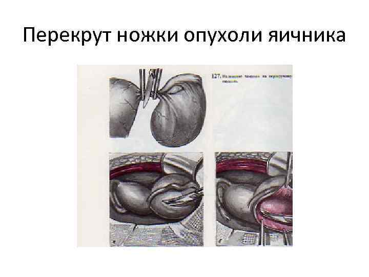 Перекрут ножки опухоли яичника 