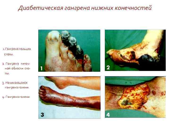 Диабетическая гангрена нижних конечностей 1. Гангрена пальцев стопы. 2. Гангрена пяточной области стопы. 3.