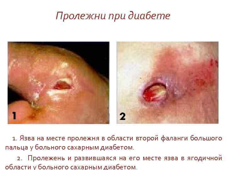 Пролежни при диабете 1. Язва на месте пролежня в области второй фаланги большого пальца