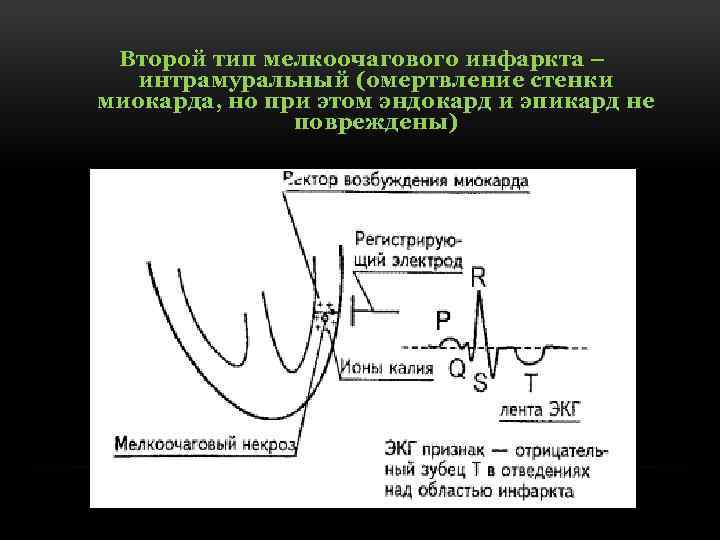 Второй тип мелкоочагового инфаркта – интрамуральный (омертвление стенки миокарда, но при этом эндокард и